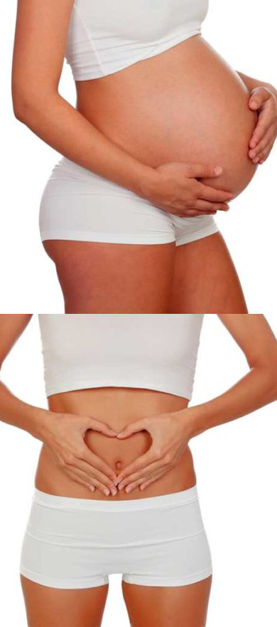 cirujano-plastico-monterrey-abdominoplastia2