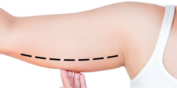 cirujano-plastico-monterrey-braquioplastia